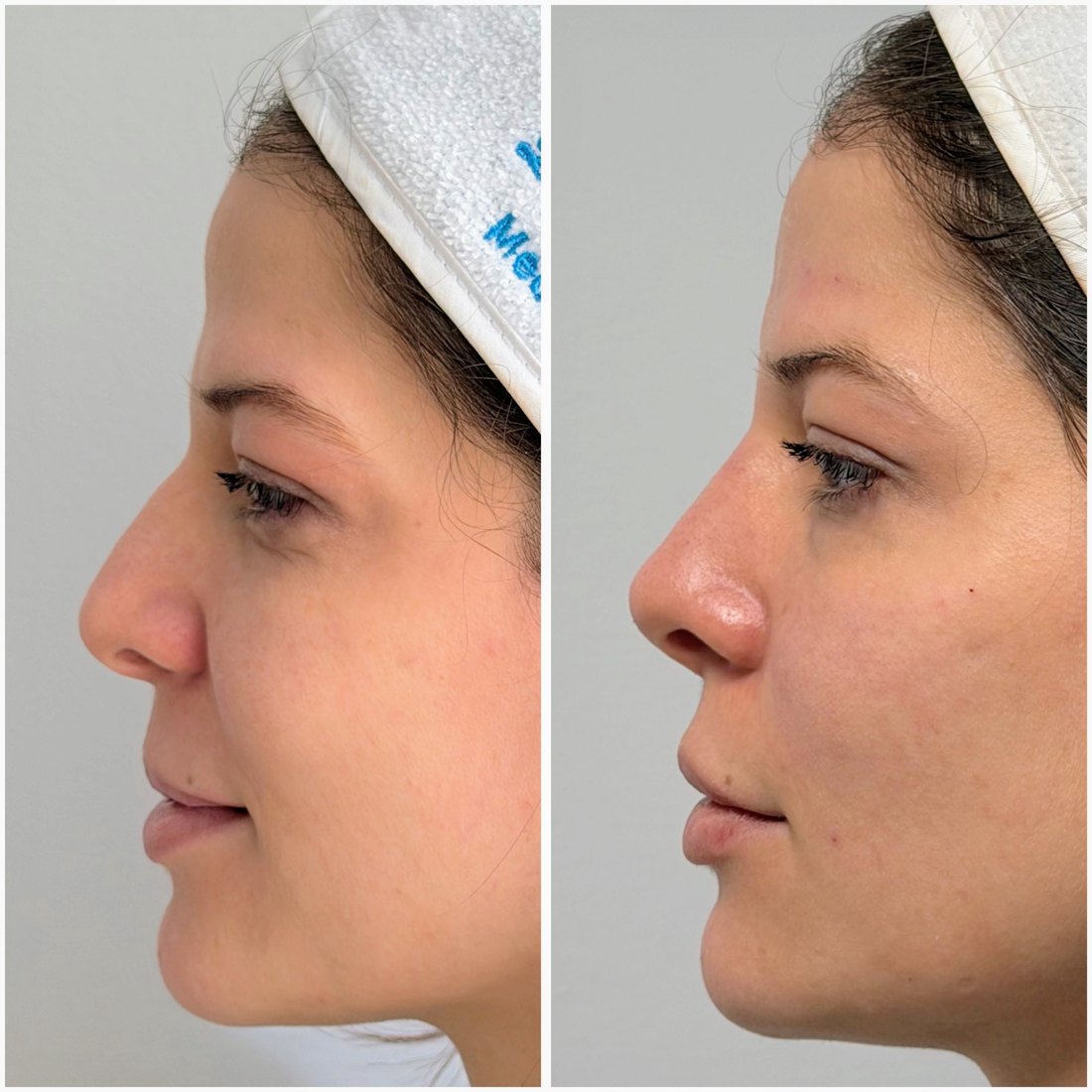 Antes y después de armonización facial, perfil