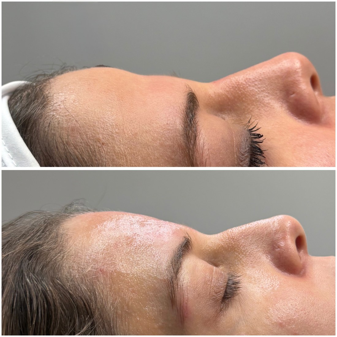 Antes y después de armonización del contorno frontal con ácido hialurónico, perfil