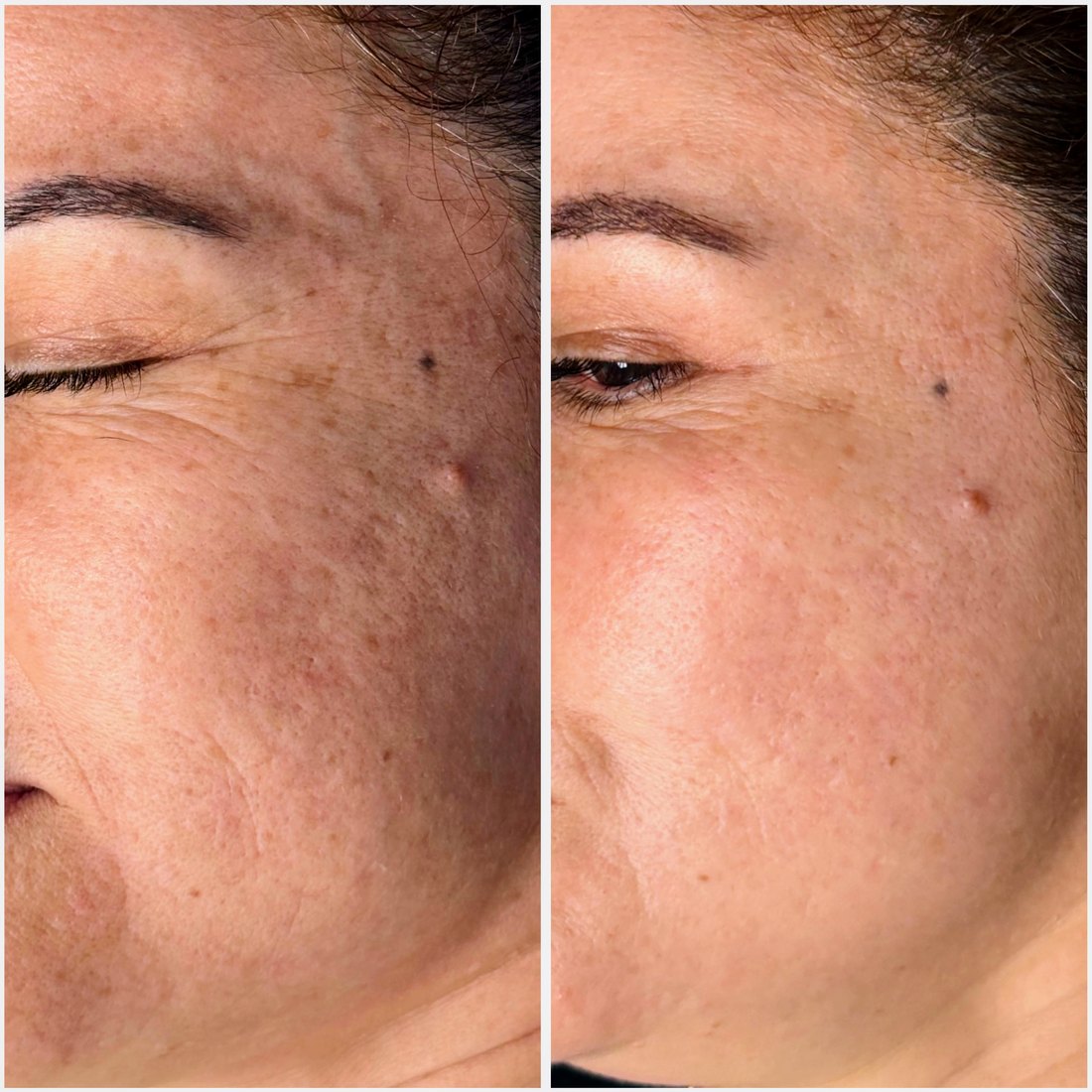 Antes y después de mesoterapia de redensificación con Redenx — textura y calidad de la piel