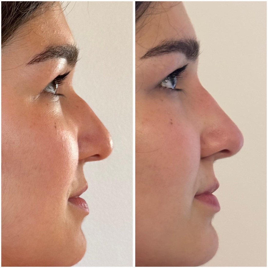 Antes y después de rinomodelación con ácido hialurónico, perfil