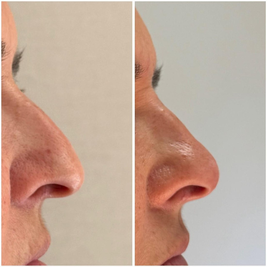 Antes y después de rinomodelación con ácido hialurónico, perfil