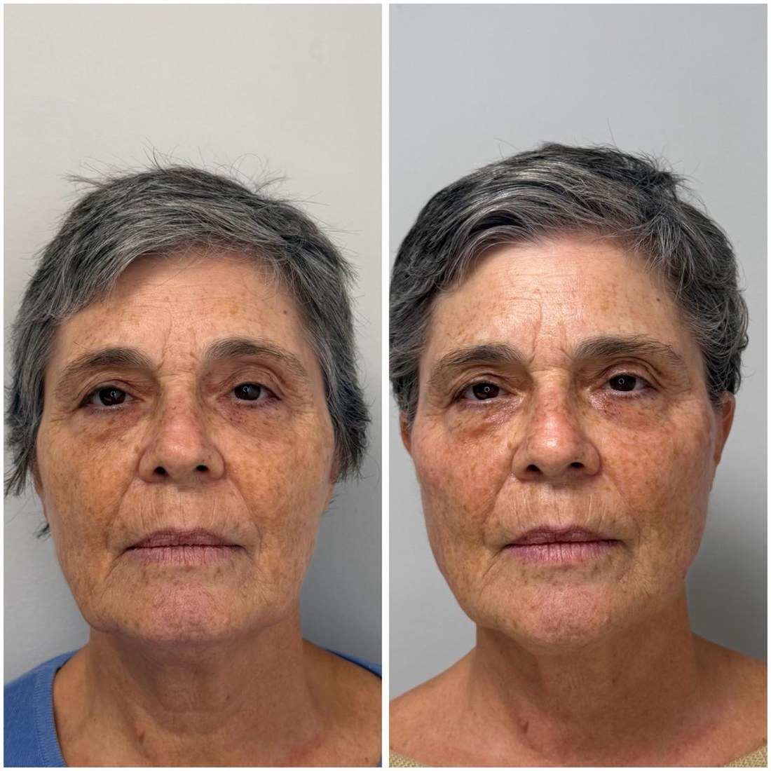 Antes y después de tratamiento facial completo — bioestimulador y ácido hialurónico
